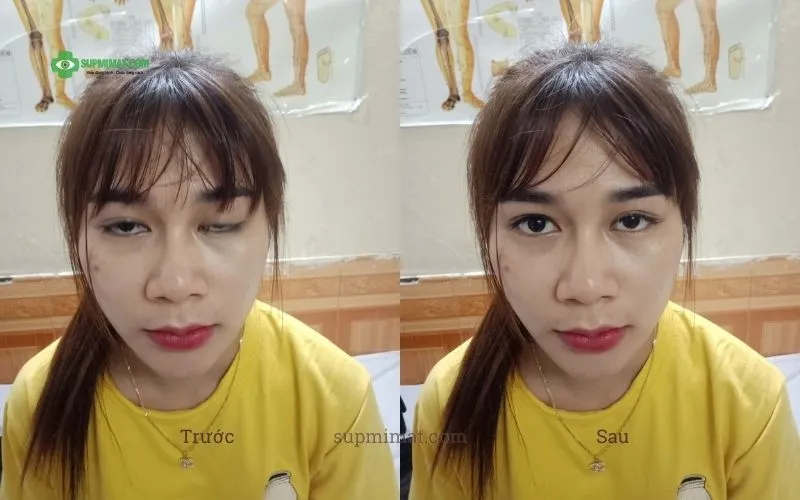 Trang chủ Chữa sụp mí mắt ở đâu?