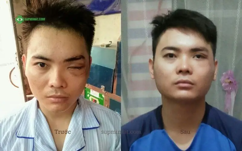 Trang chủ dieu-tri-sup-mi-mat-bang-dong-y-03