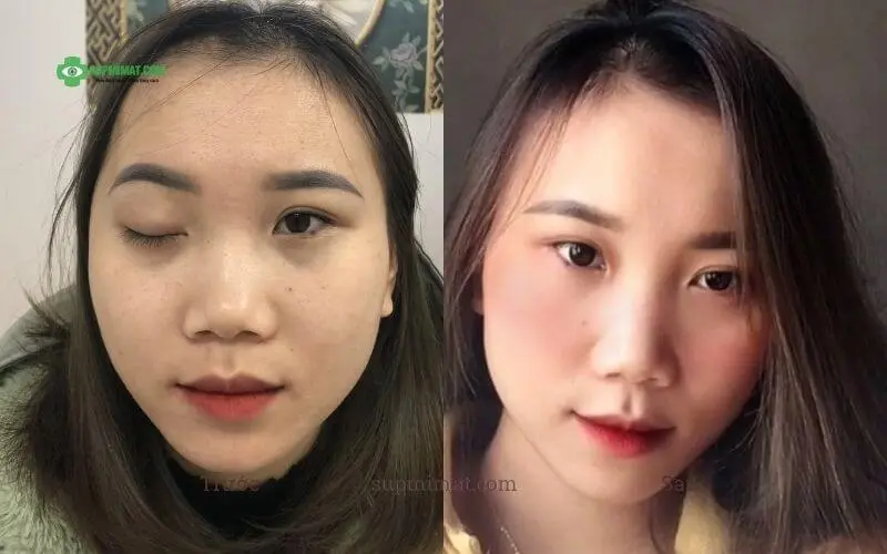 Trang chủ dieu-tri-sup-mi-mat-bang-dong-y