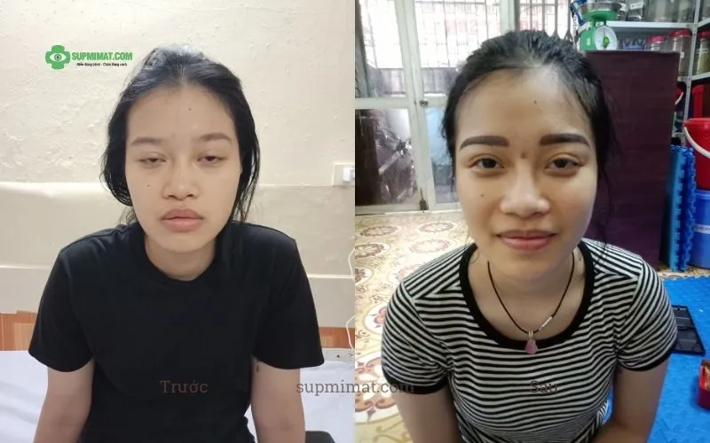 Trang chủ dieu-tri-sup-mi-mat-sau-sinh