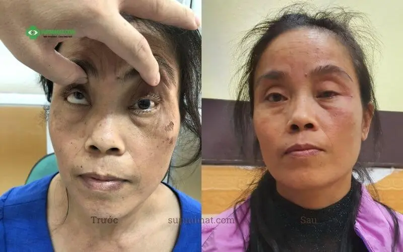 Trang chủ Hình ảnh trước và sau điều trị sụp mi do tai nạn tại Đông y Sơn Hà