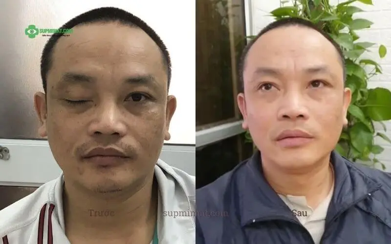Trang chủ dieu-tri-sup-mi-mat-sau-tai-nan-02