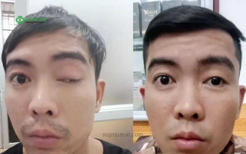 Trang chủ Điều trị sụp mí mắt