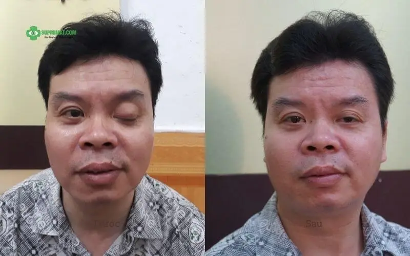Trang chủ Sụp mi mắt do liệt dây thần kinh sọ số III