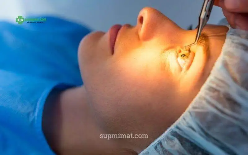 Trang chủ Điều trị sụp mí mắt bằng phẫu thuật