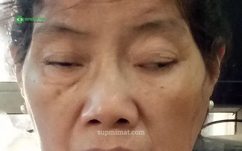 Trang chủ Sụp mí mắt do biến chứng bệnh tiểu đường