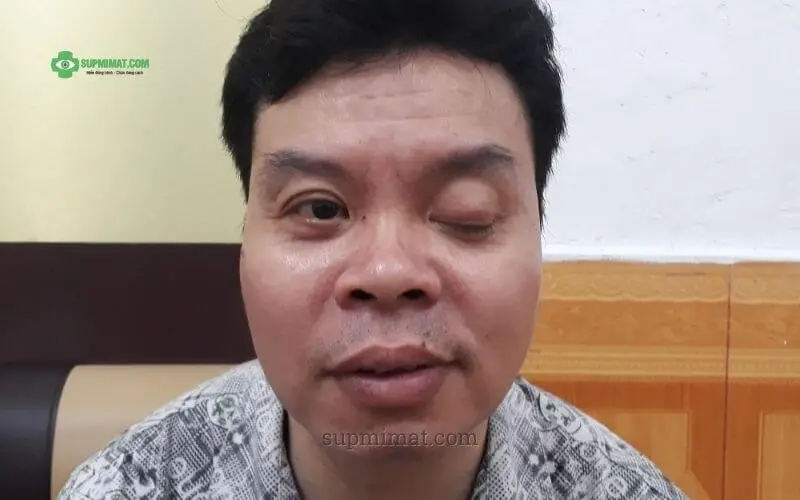 Trang chủ Sụp Mí mắt do chấn thương