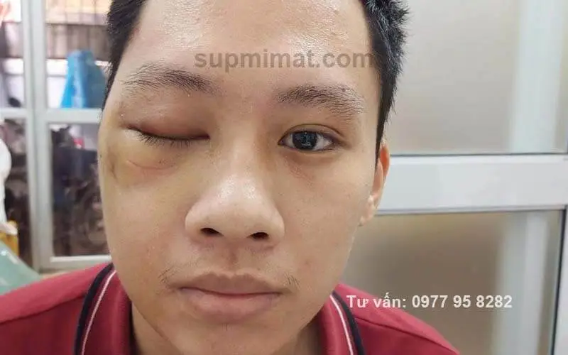 Trang chủ Sụp mí mắt do liệt dây thần kinh sọ số III