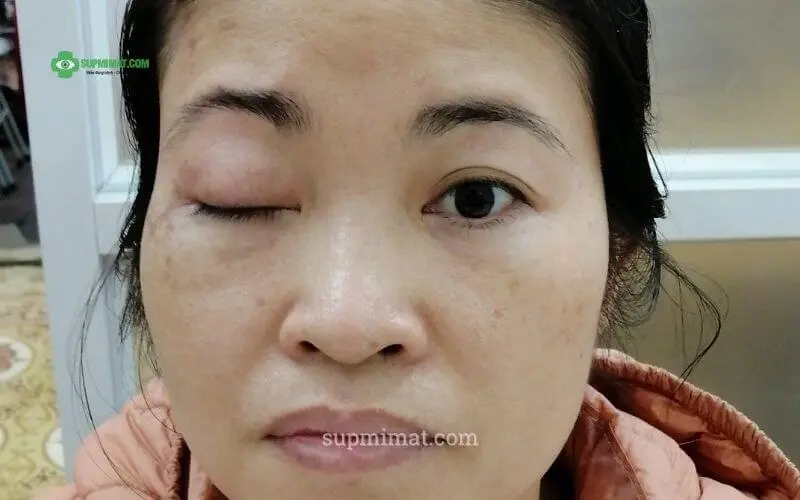 Trang chủ Sụp mí mắt do liệt dây thần kinh sọ số III