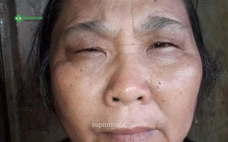 Trang chủ Sụp mí mắt do cơ nâng mi yếu ở người cao tuổi