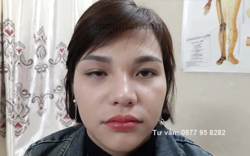 Trang chủ Sụp mí mắt do biến chứng tiêm botox
