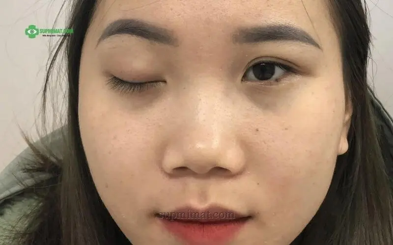Trang chủ Tổng quan về bệnh sụp mí mắt