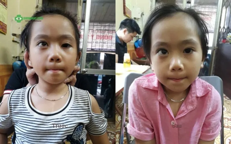 Trang chủ Hình ảnh trước và sau điều trị sụp mí mắt bẩm sinh tại Đông y Sơn Hà