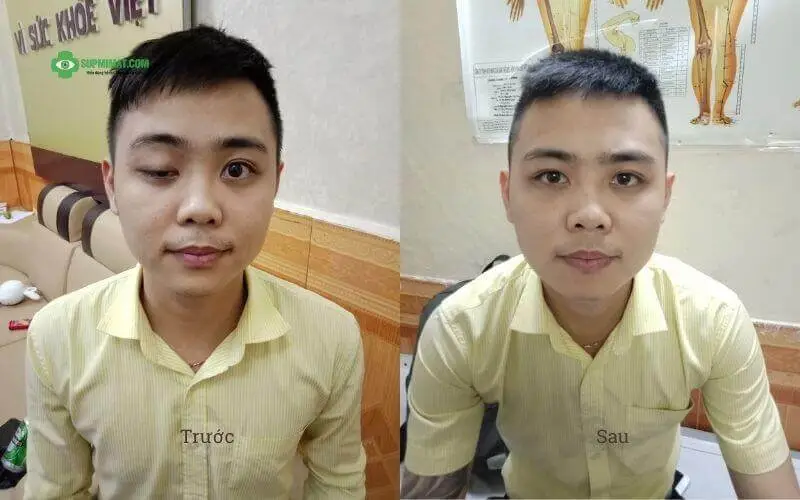 Trang chủ Sụp mí mắt do tai nạn giao thông