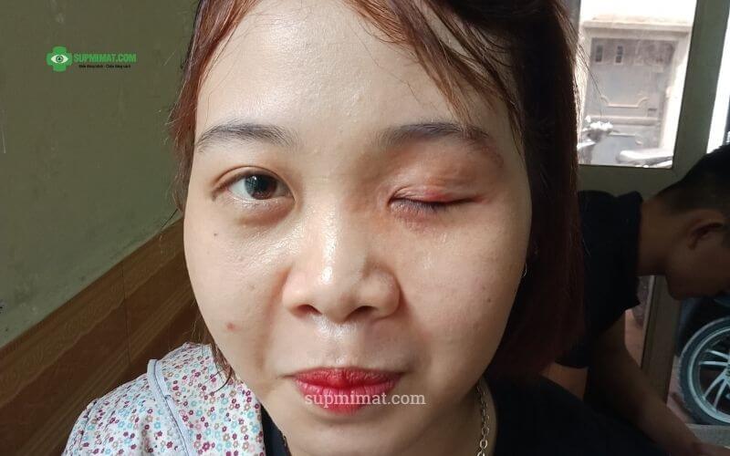 Biến chứng sau phẫu thuật nâng mí mắt