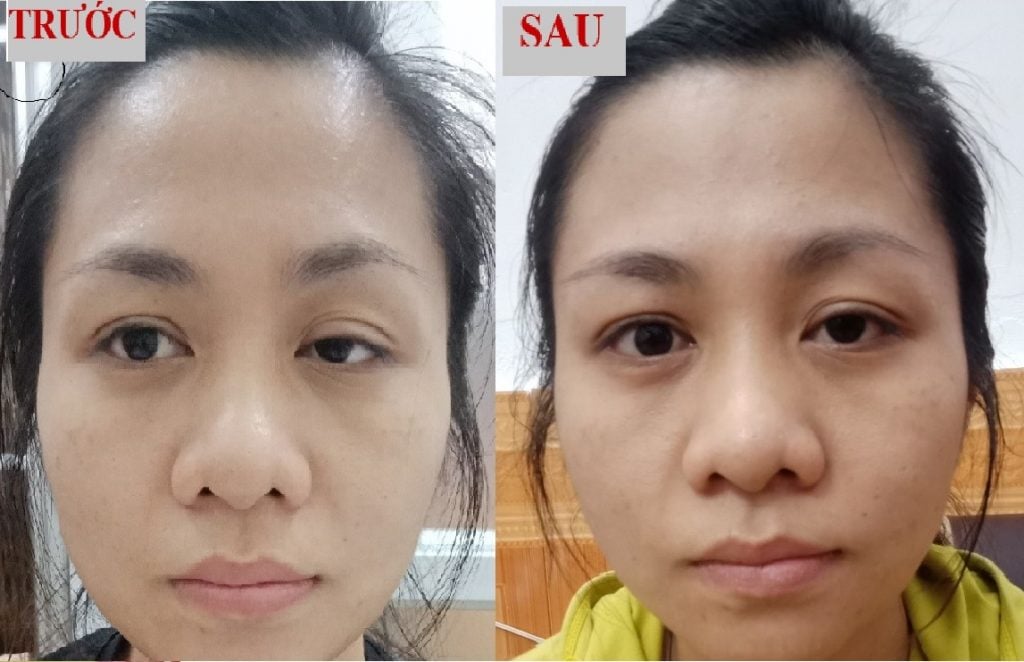 Hình ảnh trước và sau điều trị sụp mí mắt bằng Đông y - Bệnh nhân bị sụp mí mắt sau sinh