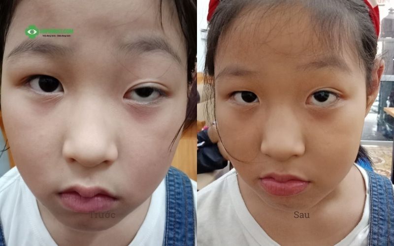 Hình ảnh trước và sau điều trị sụp mí bẩm sinh bằng Đông y