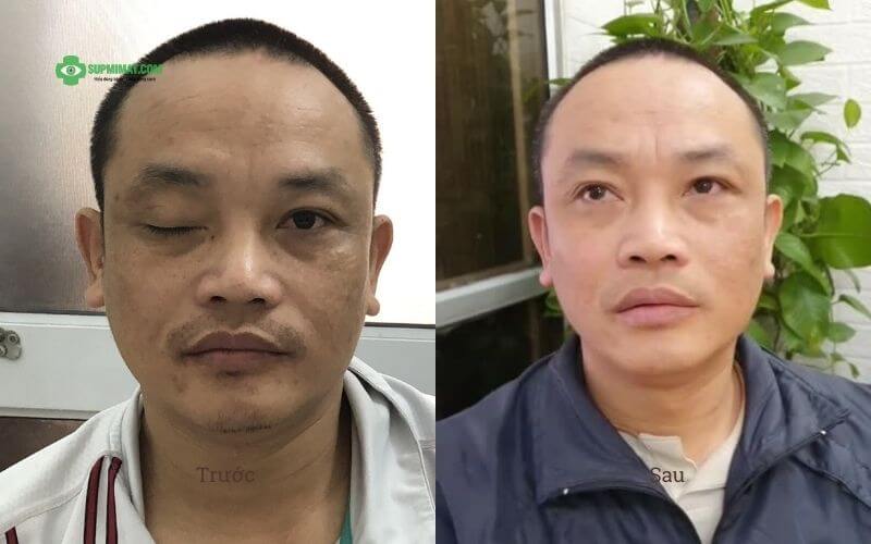 Hình ảnh trước và sau điều trị sụp mí mắt không phẫu thuật