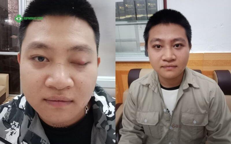 Hình ảnh trước và sau điều trị sụp mí mắt không phẫu thuật tại Đông y Sơn Hà
