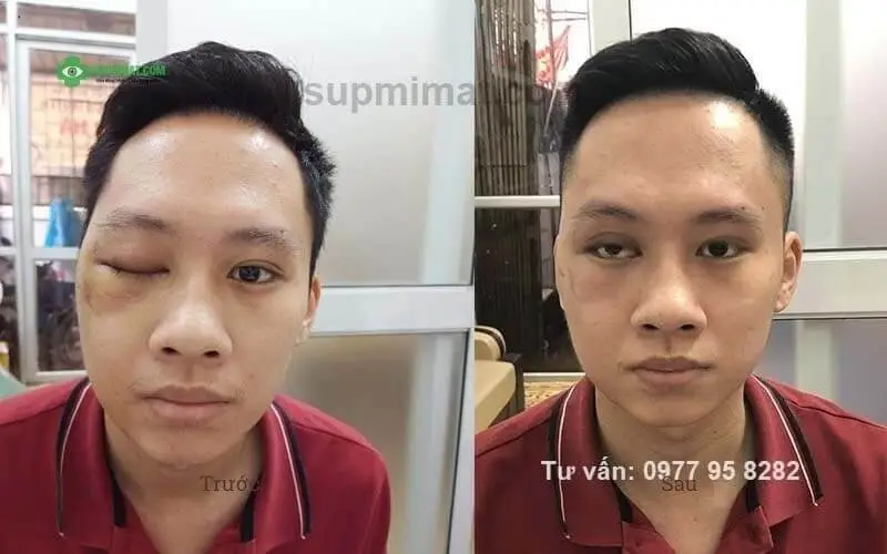 Hình ảnh trước và sau điều trị sụp mi do tai nạn tại Đông y Sơn Hà